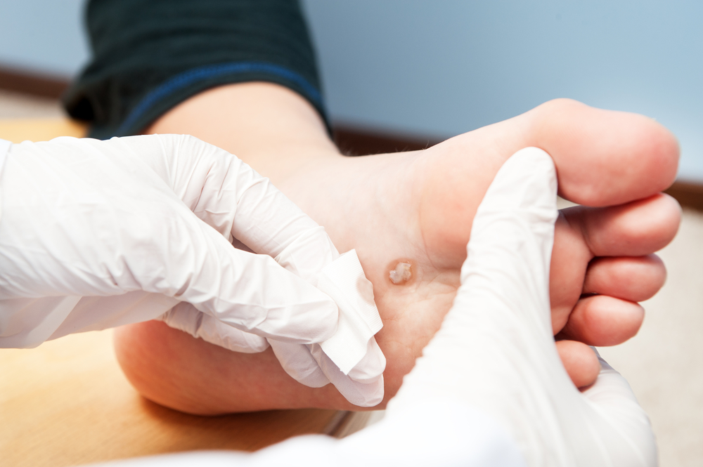 Podiatrist examining a plantar wart on the foot